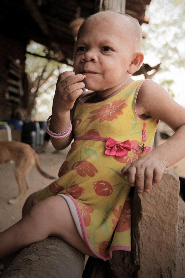 40-Year-Old Child: A New Case