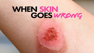 When Skin Goes Wrong