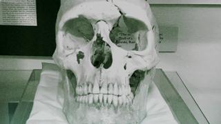 Phineas Gage's Skull