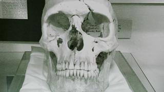 Phineas Gage's Skull