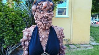 The Woman Covered in Thousands of Tumors