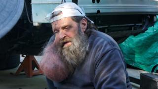 The Man With the Talking Neck Tumor