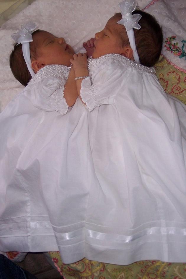 Conjoined Twins: After Separation