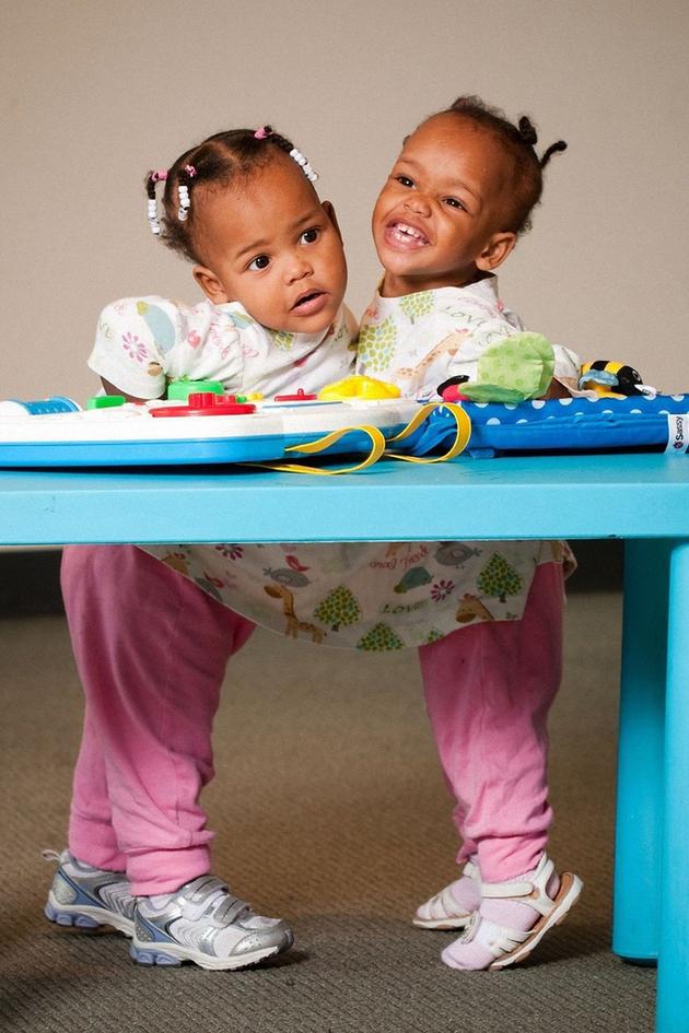 Conjoined Twins: Separation Anxiety
