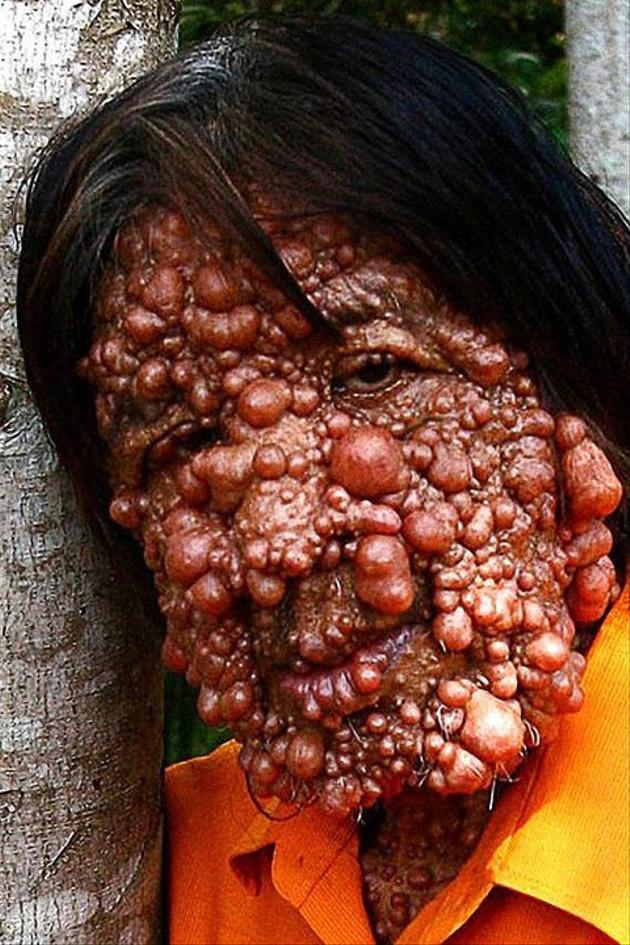 Bubble Skin Man