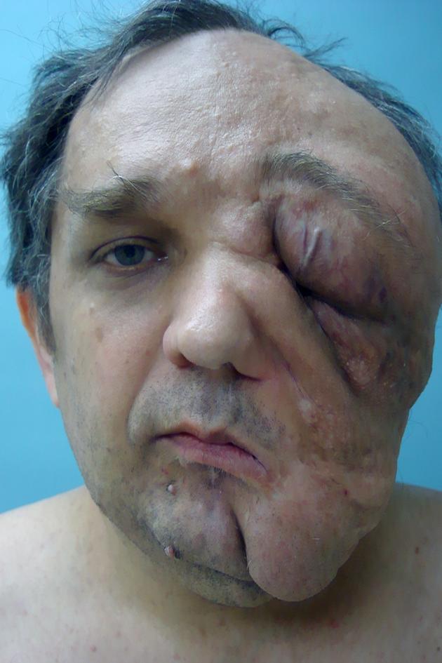 My Giant Face Tumor